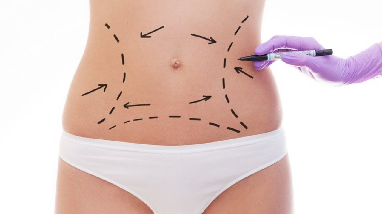 lazer liposuction